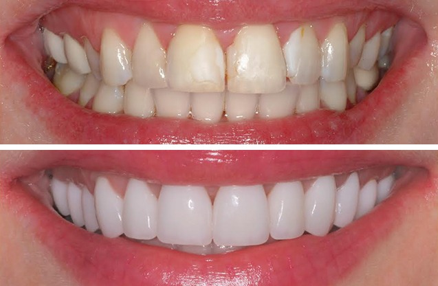 app-veneers-1
