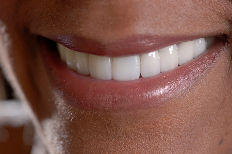 app-veneers