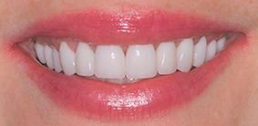 Galliano Dentistry Veneers