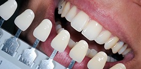 Galliano Dentistry Zoom Whitening