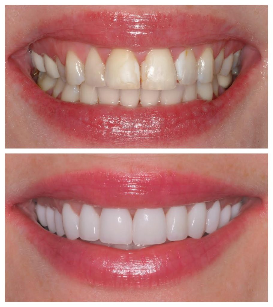 veneers_process