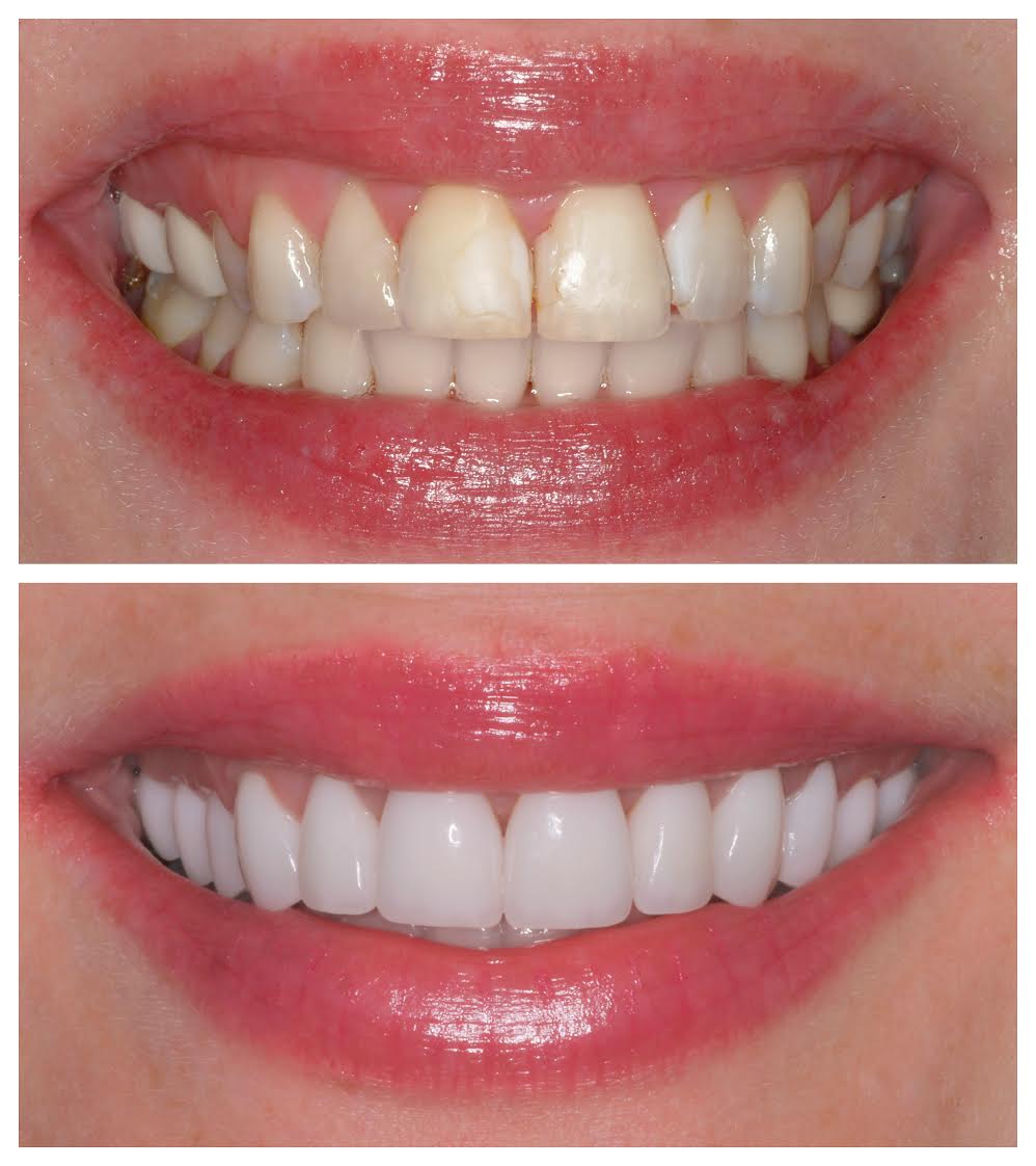 veneers_process