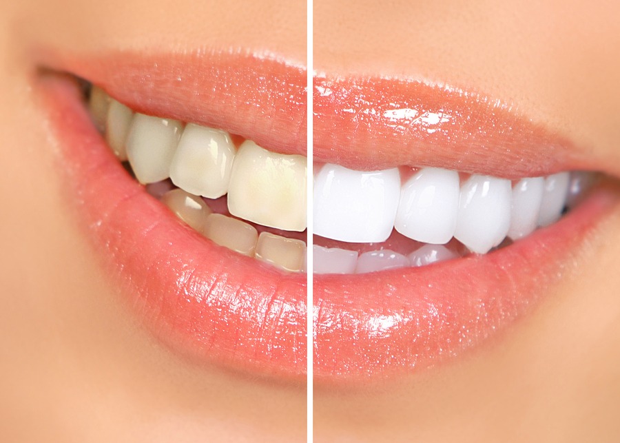 teeth whitening with Galliano