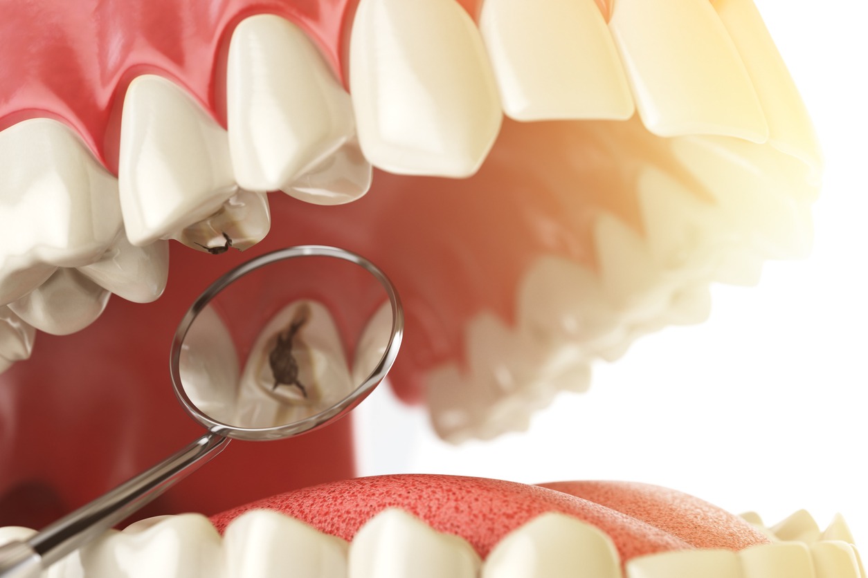 tooth fillings 