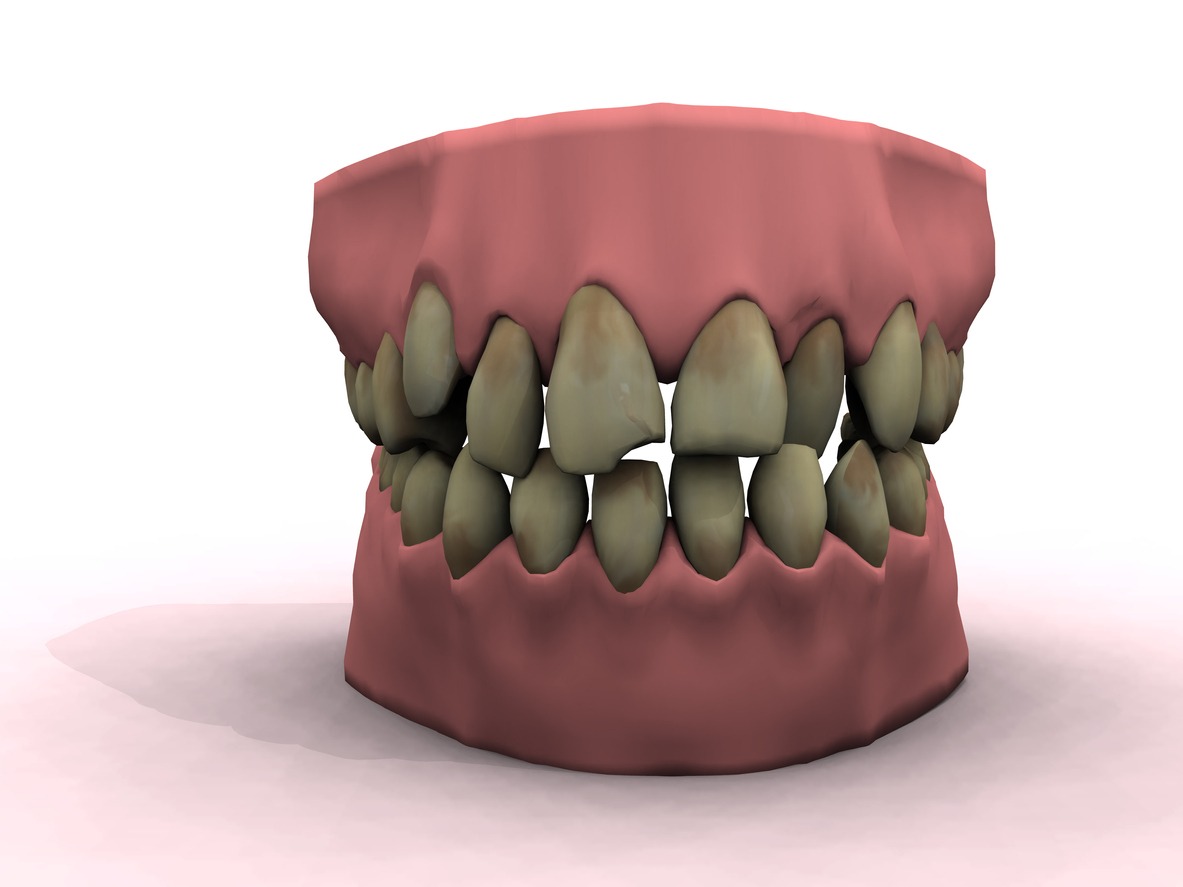 discolored teeth
