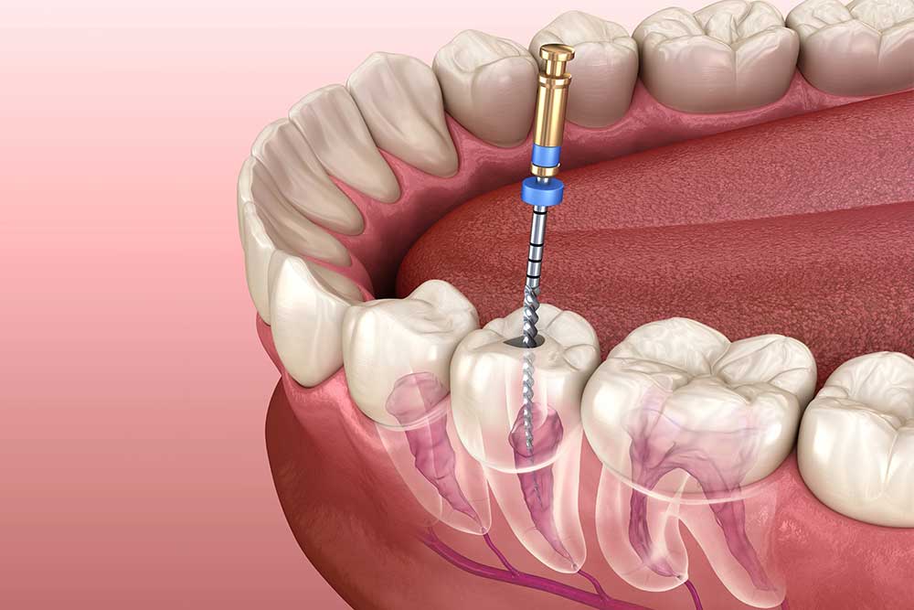 Do Root Canals Hurt During The Procedure?