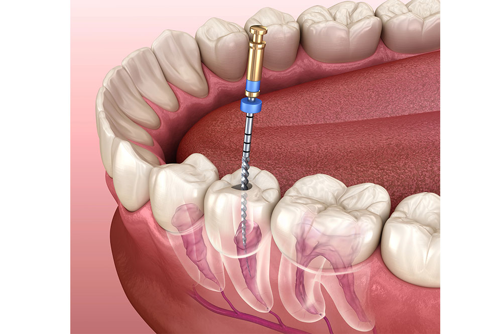 Root Canal Retreatment: When Is It Necessary?