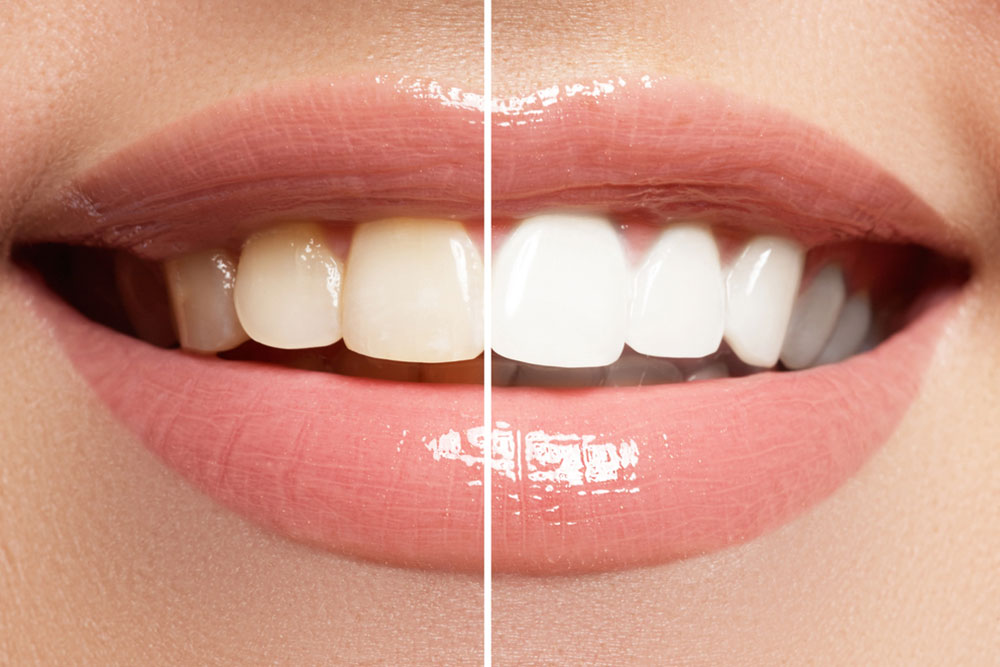 The Best Teeth Whitening Method For Yellowing Teeth