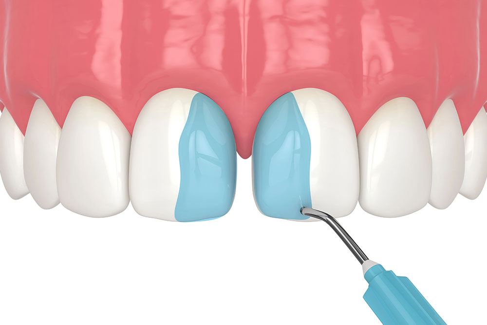 Veneers Vs. Bonding: Which Cosmetic Solution Suits You?
