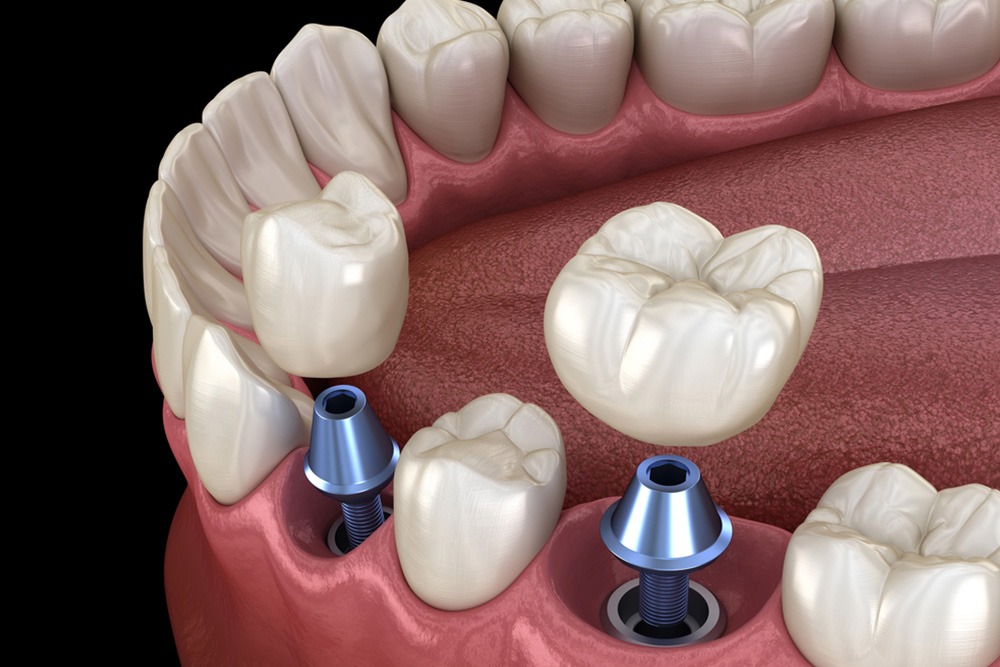 Dental Implants Vs. Bridges: Which One Is Best For Your Smile
