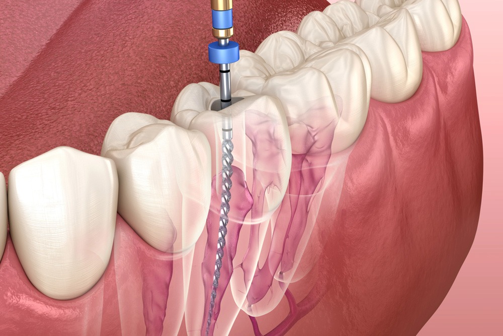 Root Canal Vs. Tooth Extraction: Which One Is Best For You?
